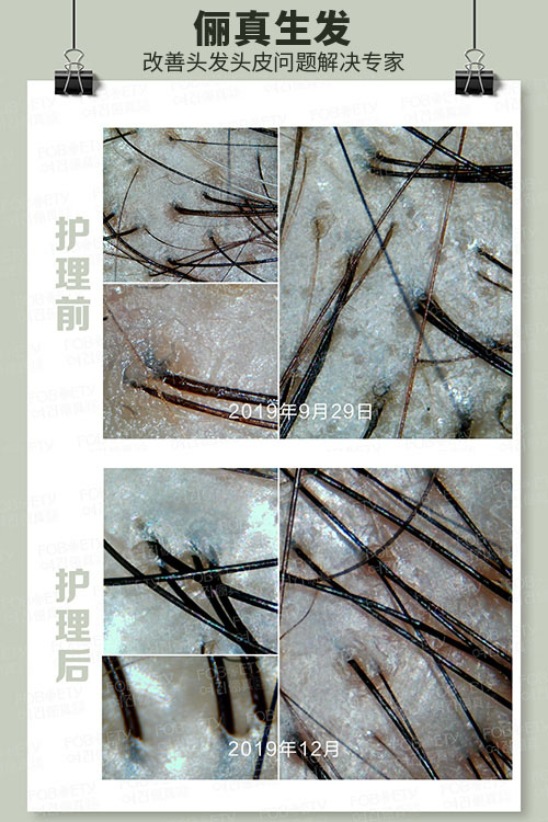 頭油、頭癢