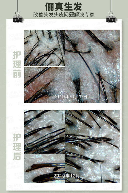 頭油、頭癢