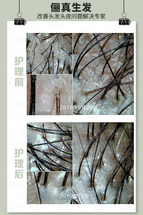 頭油、頭癢